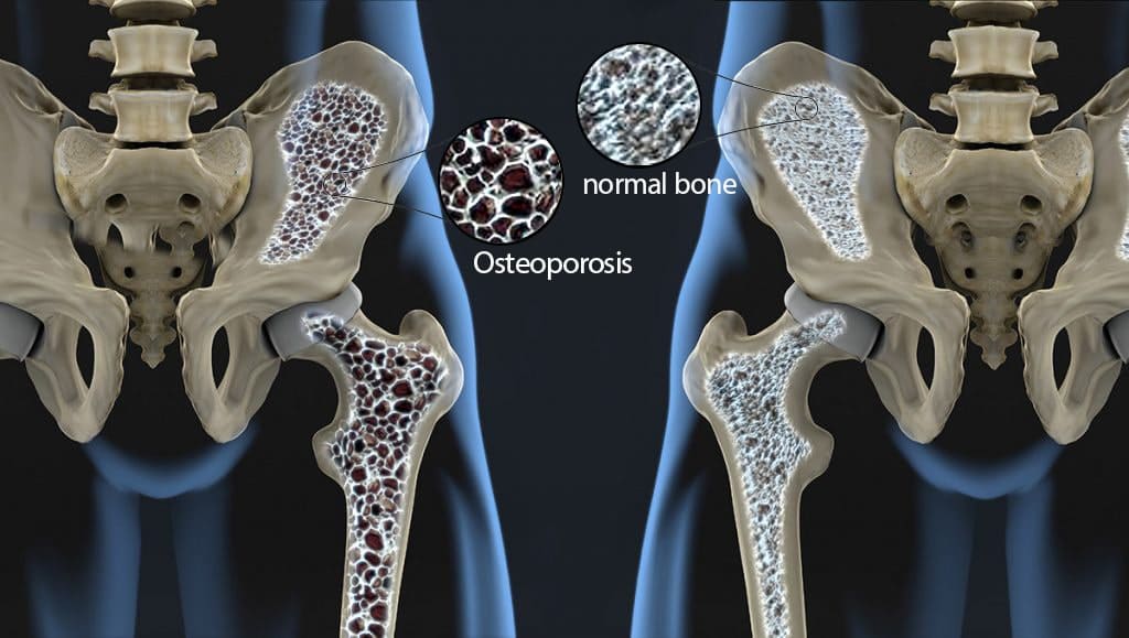 bone densito-min-min.jpg